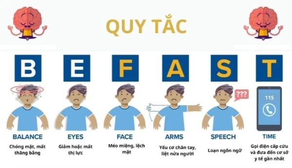 so sánh quy tắc đột quỵ BE FAST và FAST 2