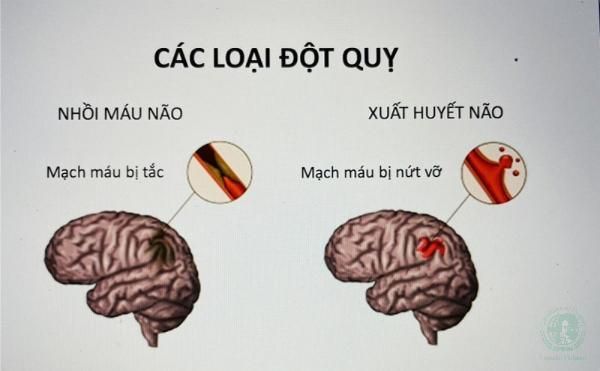 tai biến và đột quỵ khác nhau không