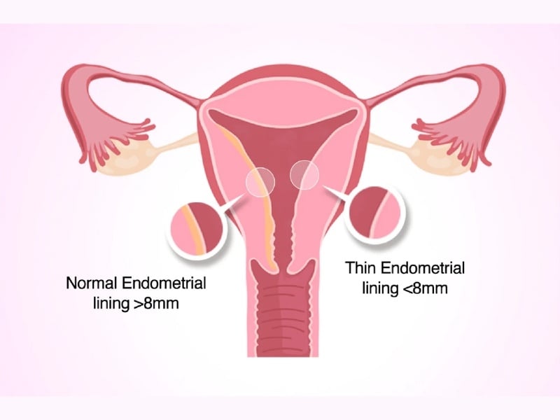 Niêm mạc tử cung mỏng nên ăn gì để cải thiện?
