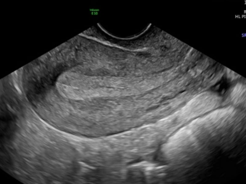 Niêm mạc tử cung mỏng nên ăn gì để cải thiện?