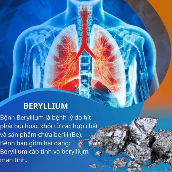 Berylium và mối nguy hại với sức khỏe