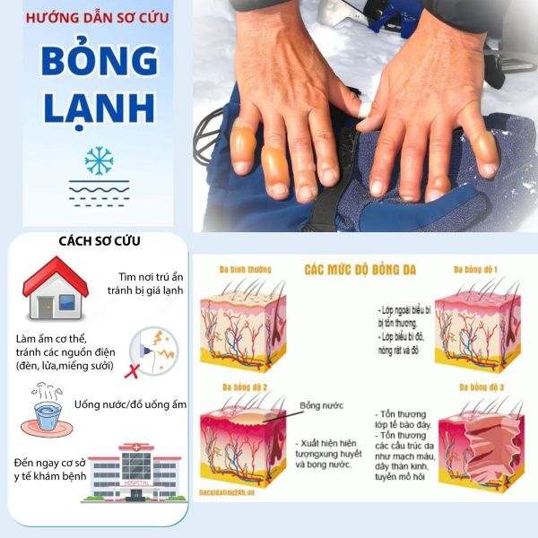 Hướng dẫn sơ cứu khi bỏng lạnh