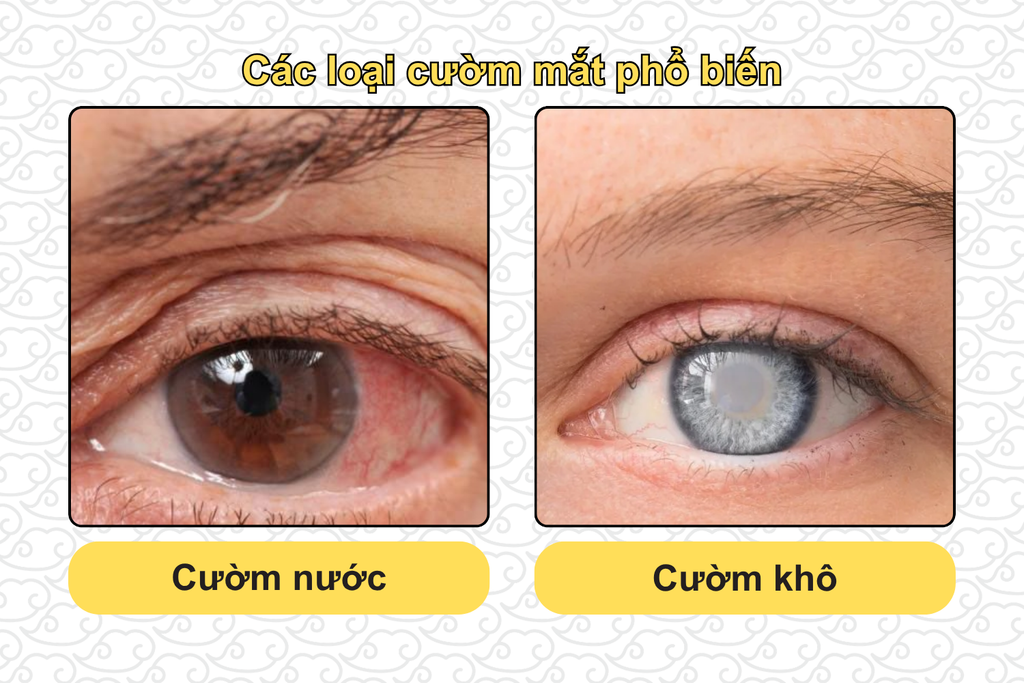 cac-loai-cuom-mat-pho-bien