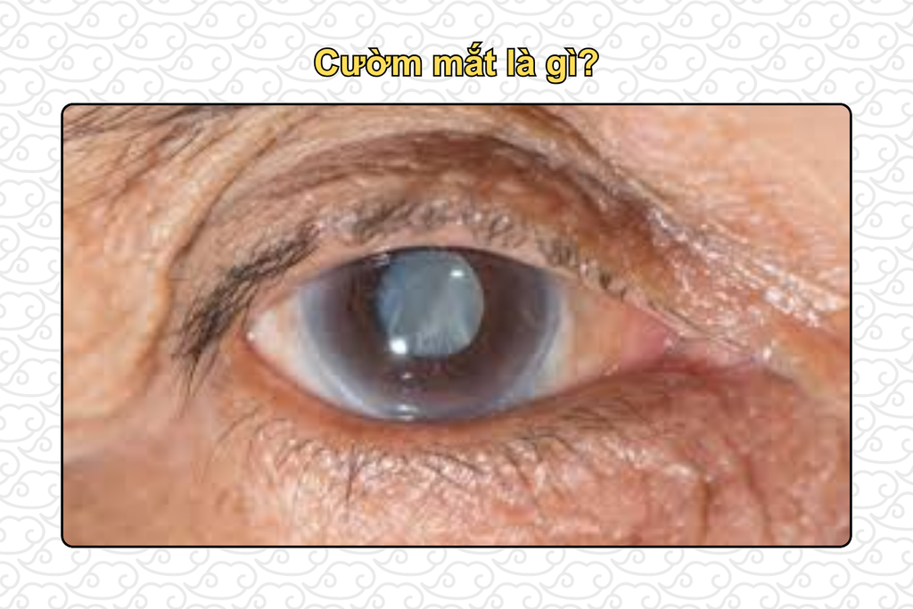 cuom-mat-la-gi