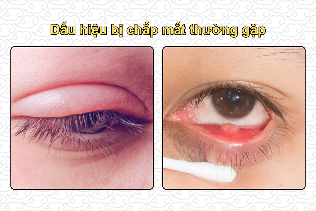 dau-hieu-bi-chap-mat