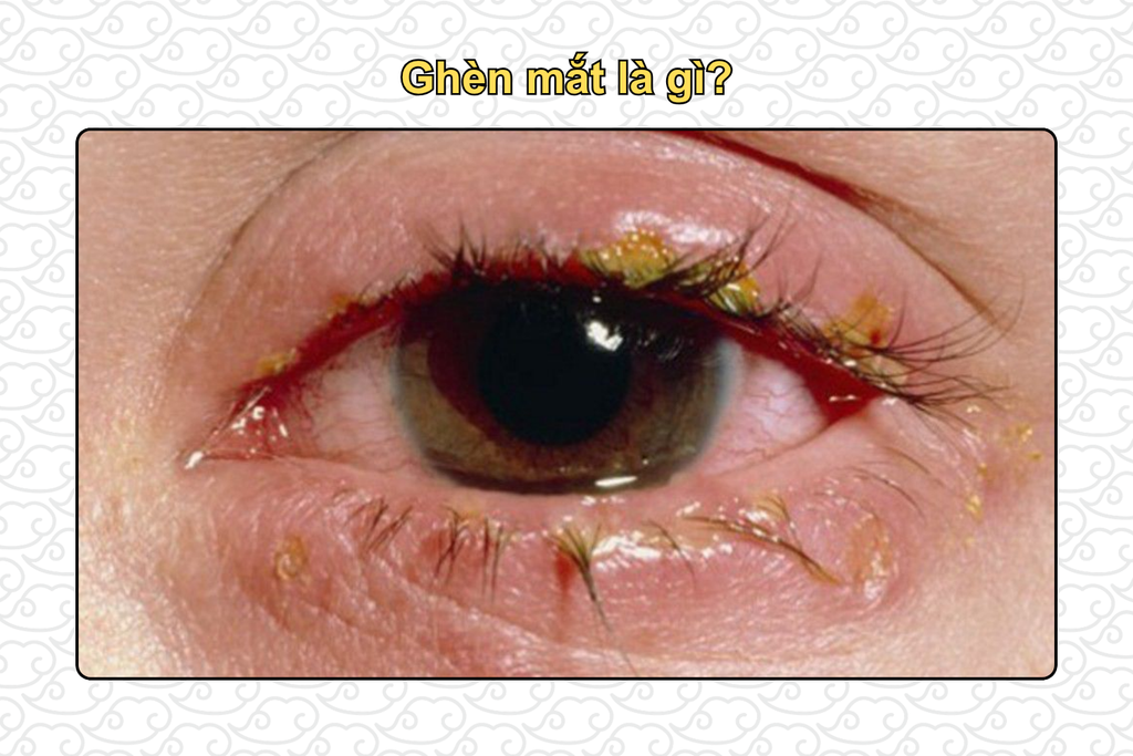 ghen-mat-la-gi