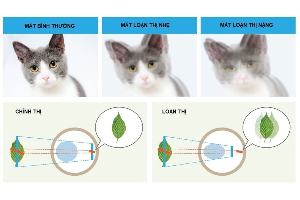 Loạn thị còn có thể đi kèm cận hoặc viễn