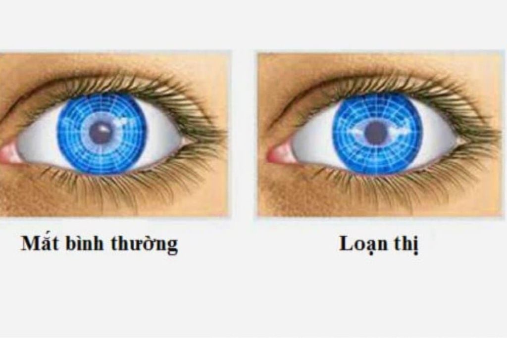 Góc nhìn của người loạn thị