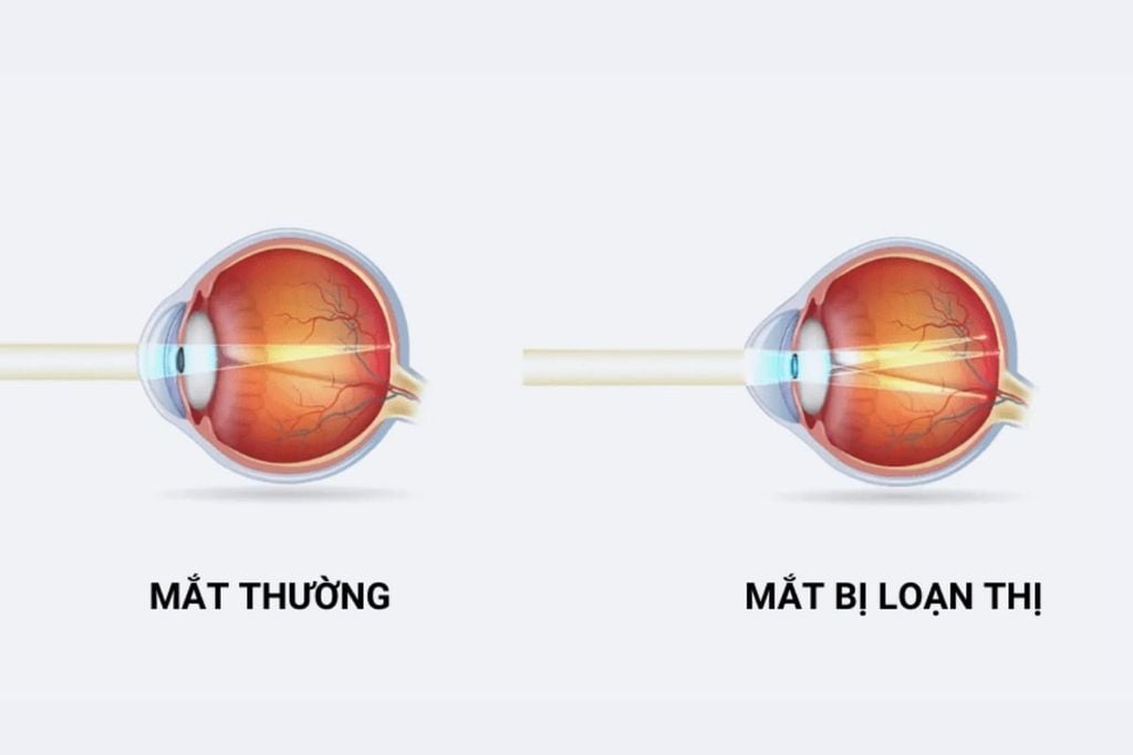 Loạn thị nhẹ nhìn như thế nào