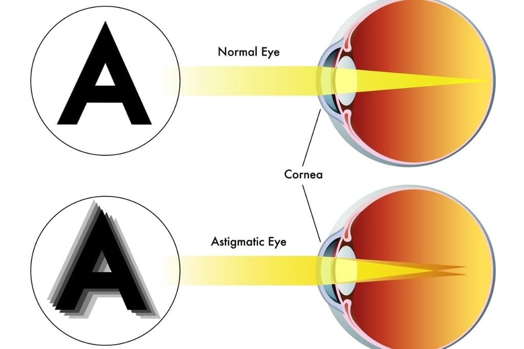 Trẻ em bị loạn thị nhìn như thế nào