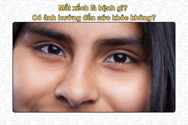 Mắt xếch là bệnh gì?  Có ảnh hưởng đến sức khỏe không?
