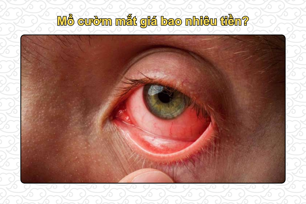 mo-cuom-mat-gia-bao-nhieu-tien