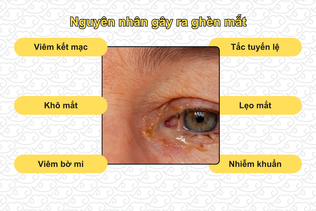 nguyen-nhan-gay-ra-ghen-mat