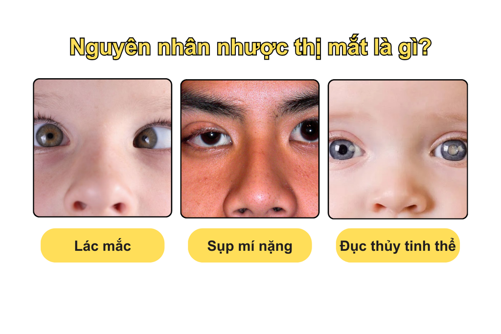 nguyen-nhan-nhuoc-thi-mat-la-gi