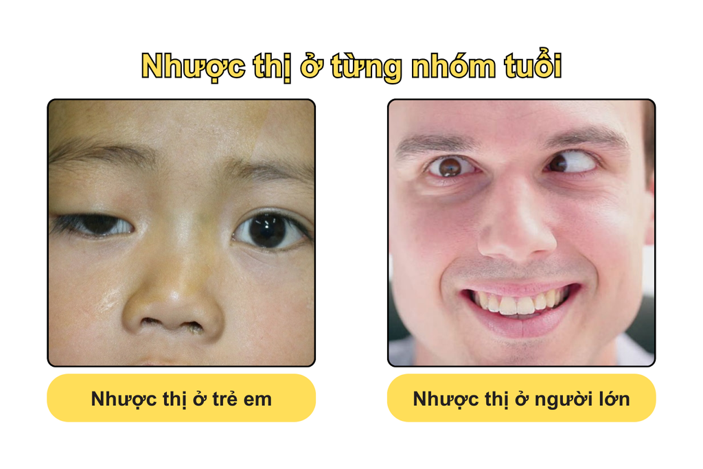 nhuoc-thi-o-tung-nhom-tuoi