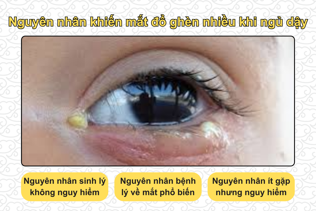 nguyen-nhan-khien-mat-do-ghen-nhieu-khi-ngu-day