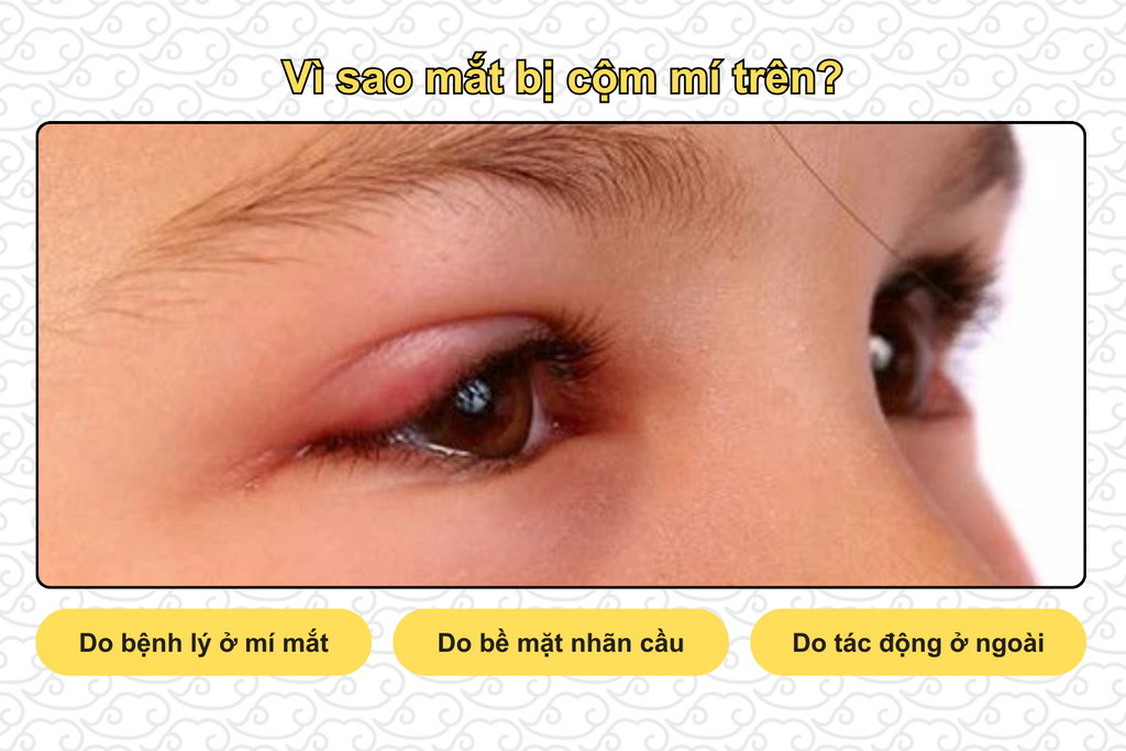 vi-sao-mat-bi-com-mi-tren