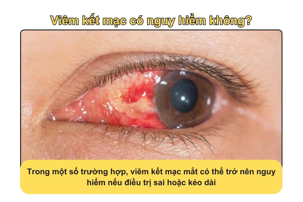 viem-ket-mac-co-nguy-hiem-khong