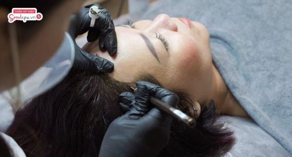 Xăm chân tóc tại Seoul Spa giúp che hói, tạo đường tóc tự nhiên