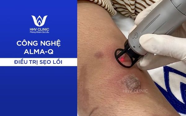 Alma điều trị sẹo hiệu quả