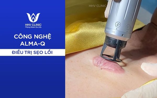 Alma điều trị sẹo