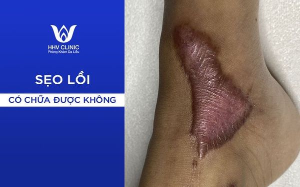 Cách Trị Sẹo Lồi Hiệu Quả 01
