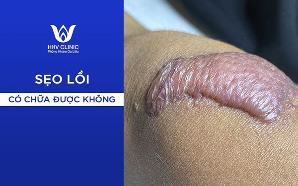 Cách Trị Sẹo Lồi Hiệu Quả 02