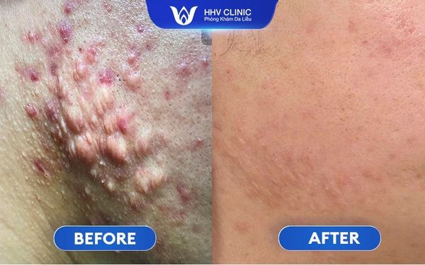 Cách Trị Sẹo Lồi Do Xóa Xăm Hiệu Quả