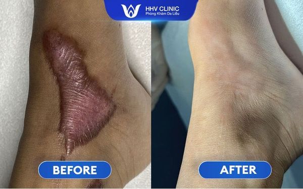 Cách Trị Sẹo Lồi Do Xóa Xăm Hiệu Quả