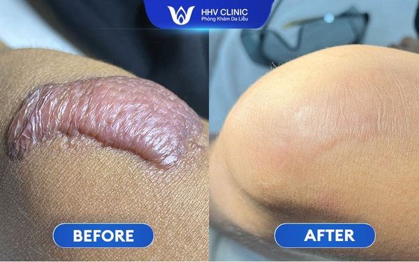 Hình Ảnh Trị Sẹo Lồi Hiệu Quả