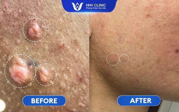 Hình Ảnh Trị Sẹo Lồi Hiệu Quả 01