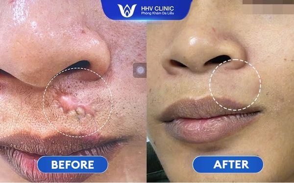 Hình Ảnh Trị Sẹo Lồi Mép Hiệu Quả