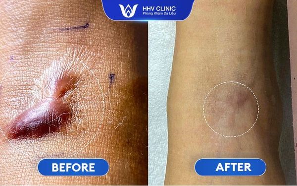 Hình Ảnh Trị Sẹo Lồi Hiệu Quả 02