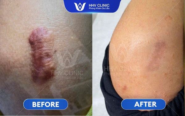 Hình Ảnh Trị Sẹo Lồi Đầu Gối Hiệu Quả