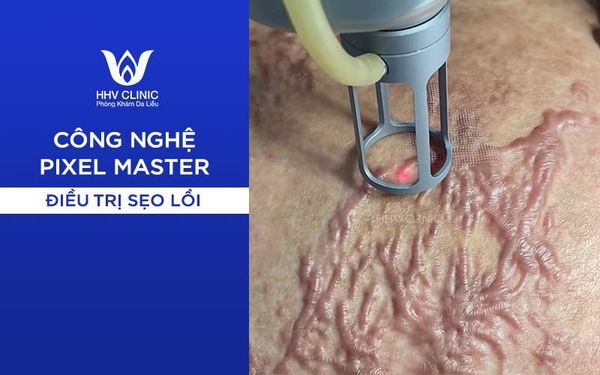 Điều Trị Sẹo Lồi Hiệu Quả Cao 02