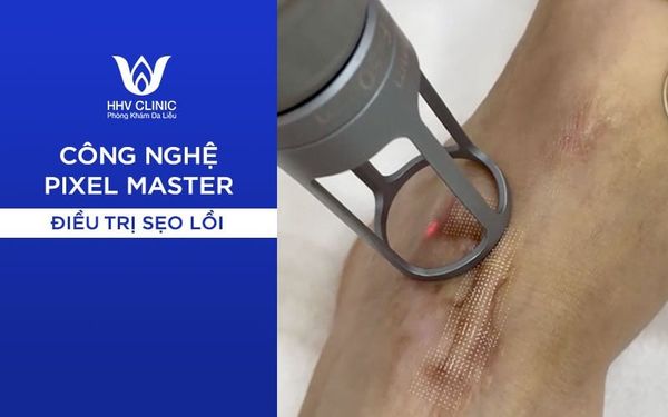 Điều Trị Sẹo Lồi Hiệu Quả Cao