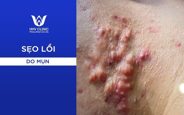 Cách Trị Sẹo Lồi Hiệu Quả 03