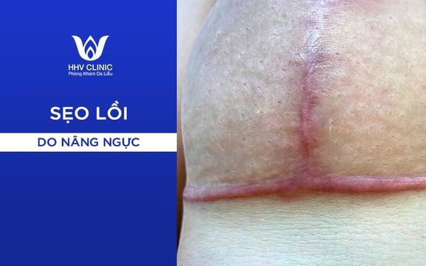 Cách Trị Sẹo Lồi Do Nâng Ngực Hiệu Quả