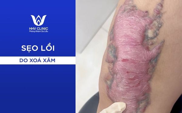Cách Trị Sẹo Lồi Do Xóa Xăm Hiệu Quả