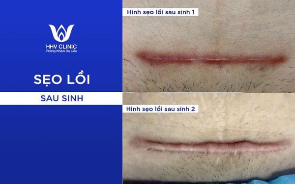Cách Trị Sẹo Lồi Sau Sinh Hiệu Quả