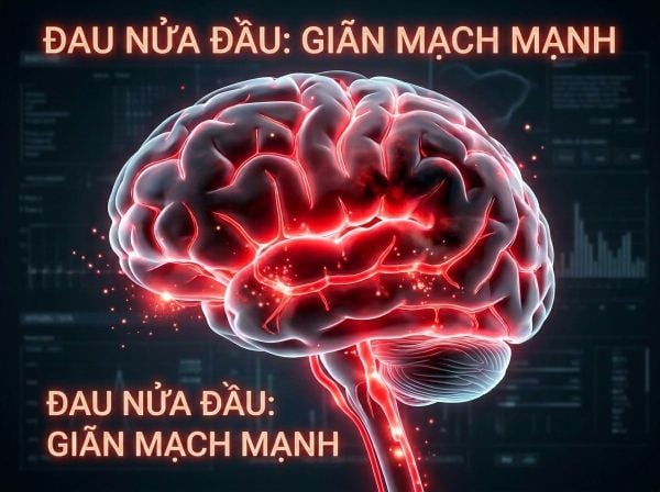 Minh họa mạch máu não bị giãn nở và co thắt gây đau nhói trong cơn Migraine.