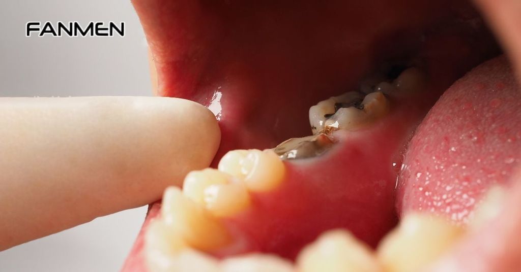 Sâu răng có gây hôi miệng không