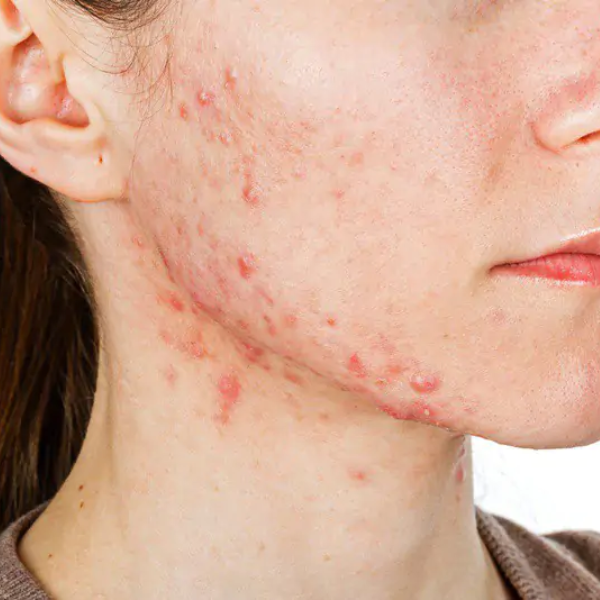 dấu hiệu da bị dị ứng mỹ phẩm