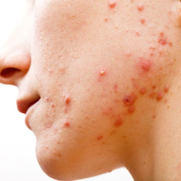 không nên tẩy da chết khi đang bị mụn viêm nặng