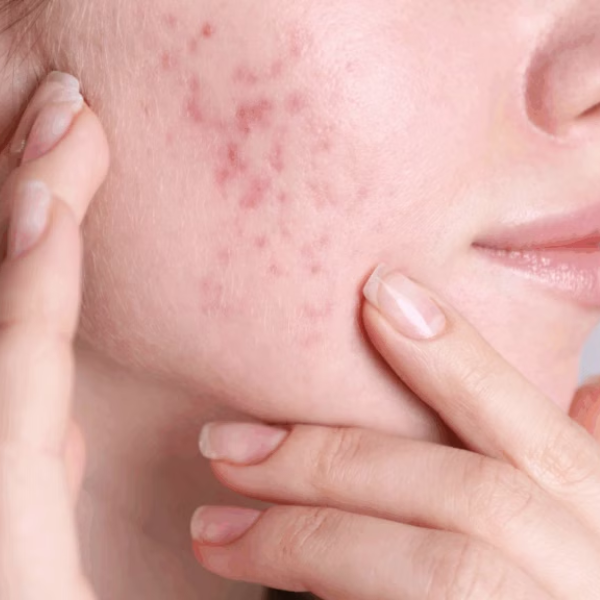Dùng nước tẩy trang bị lên mụn