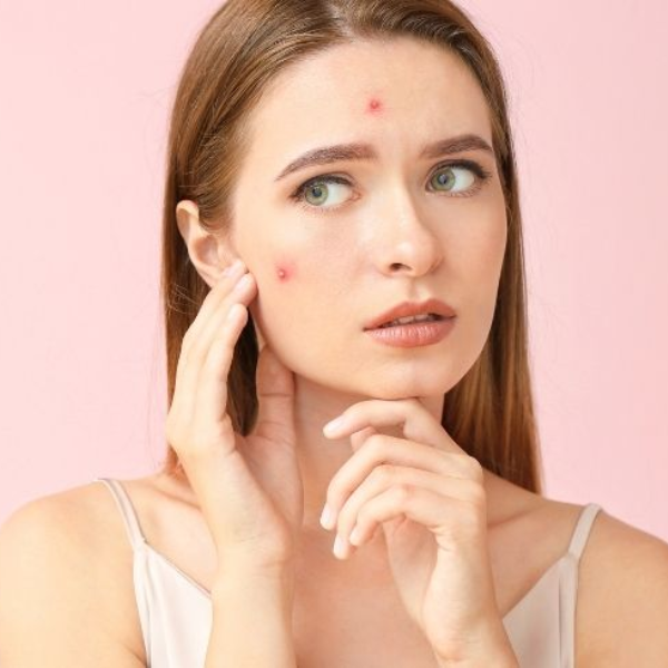 Xuất hiện mụn nước do dị ứng nước tẩy trang