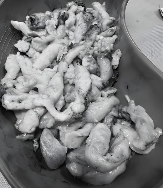 CA MỔ U XỞ TỬ CUNG CHO CHỊ KHÁCH ĐỊNH CƯ Ở MỸ