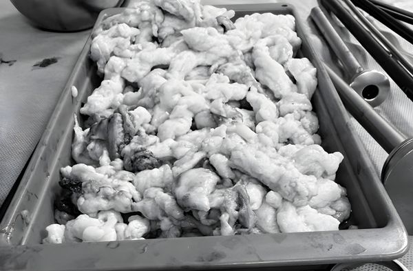 CA MỔ U TO ĐẾN 14CM CHO BỆNH NHÂN MỚI HƠN 30 TUỔI