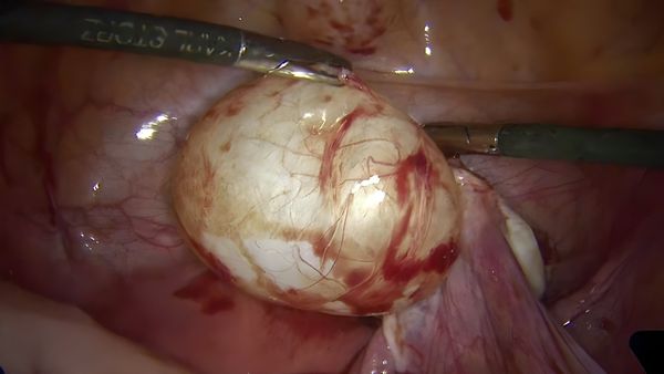 CA MỔ CHO BỆNH NHÂN BỊ NANG BUỒNG TRỨNG