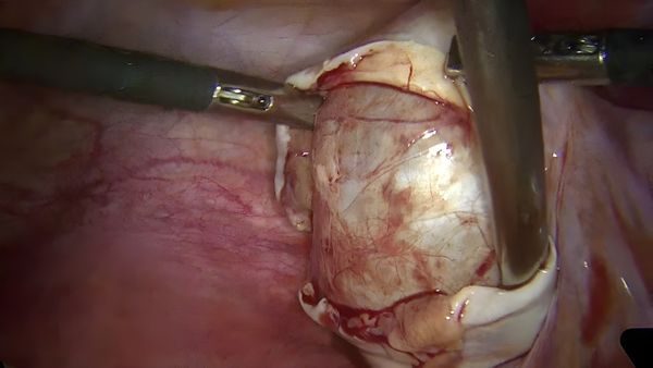CA MỔ CHO BỆNH NHÂN BỊ NANG BUỒNG TRỨNG